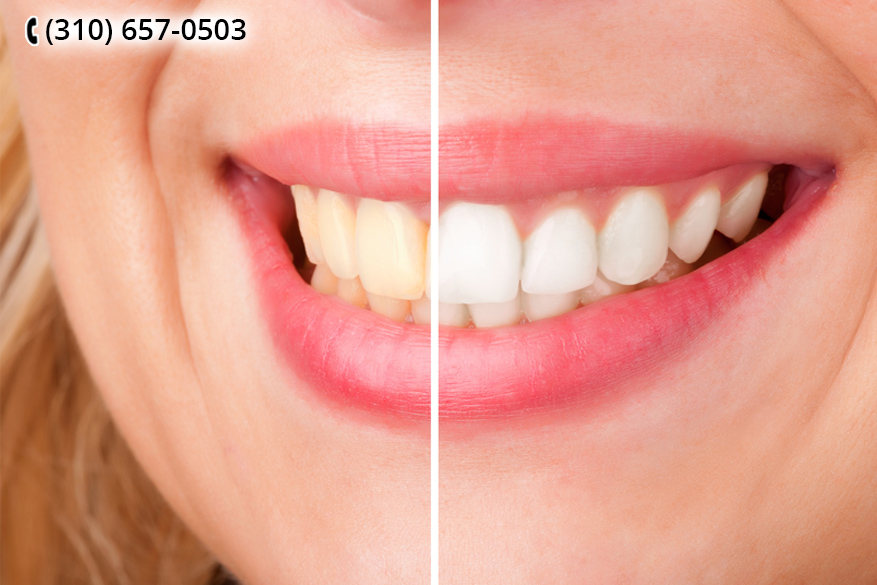 A Los Angeles Cosmetic Dentist Can Restore Smile