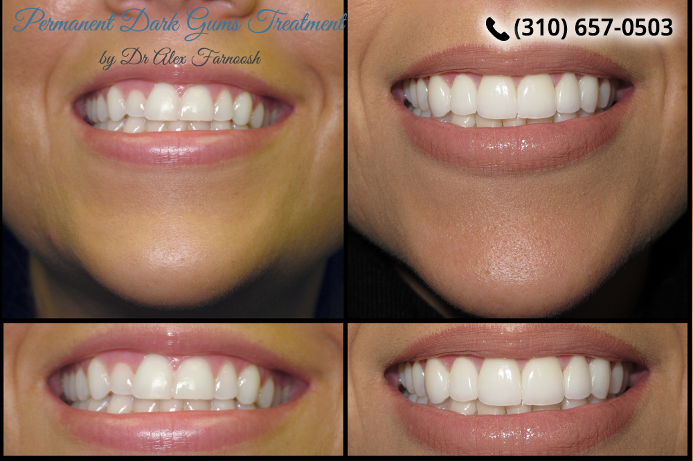 Gummy Smile Correction in Los Angeles Improves Your Smile
